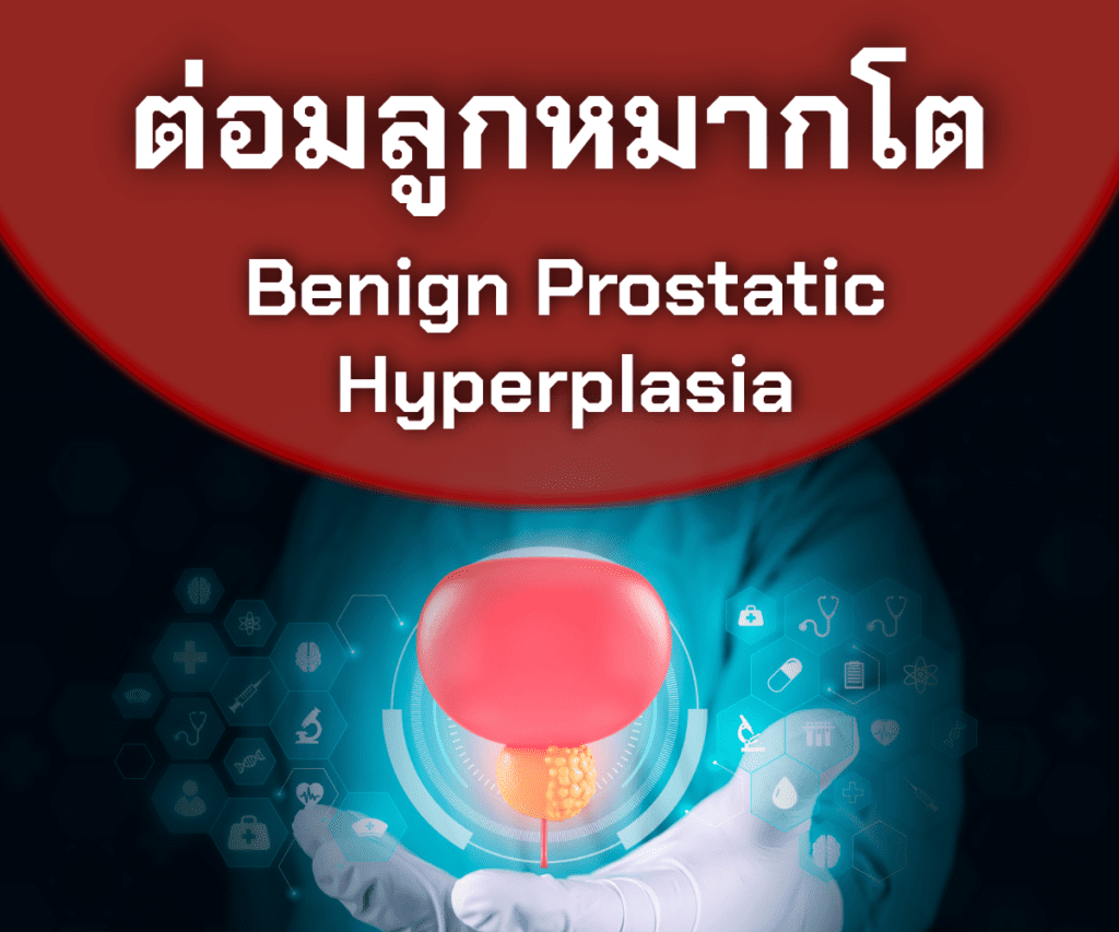 ต่อมลูกหมากโต2